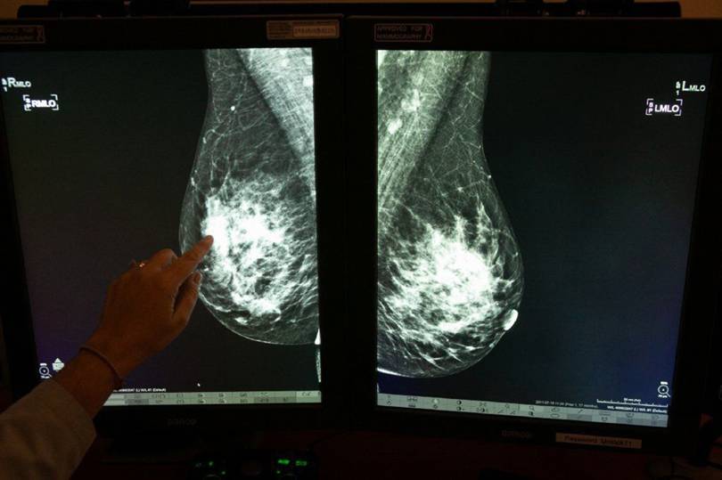 谷歌发布新的AI乳腺癌检测系统，误诊和漏诊率均低于专业放射科医生